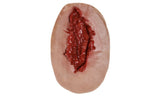 Avulsion Wound Medium