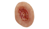 Pressure Ulcer Wound
