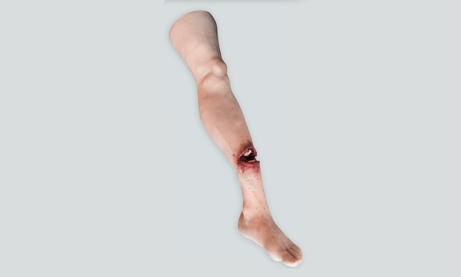 Open Fracture Leg